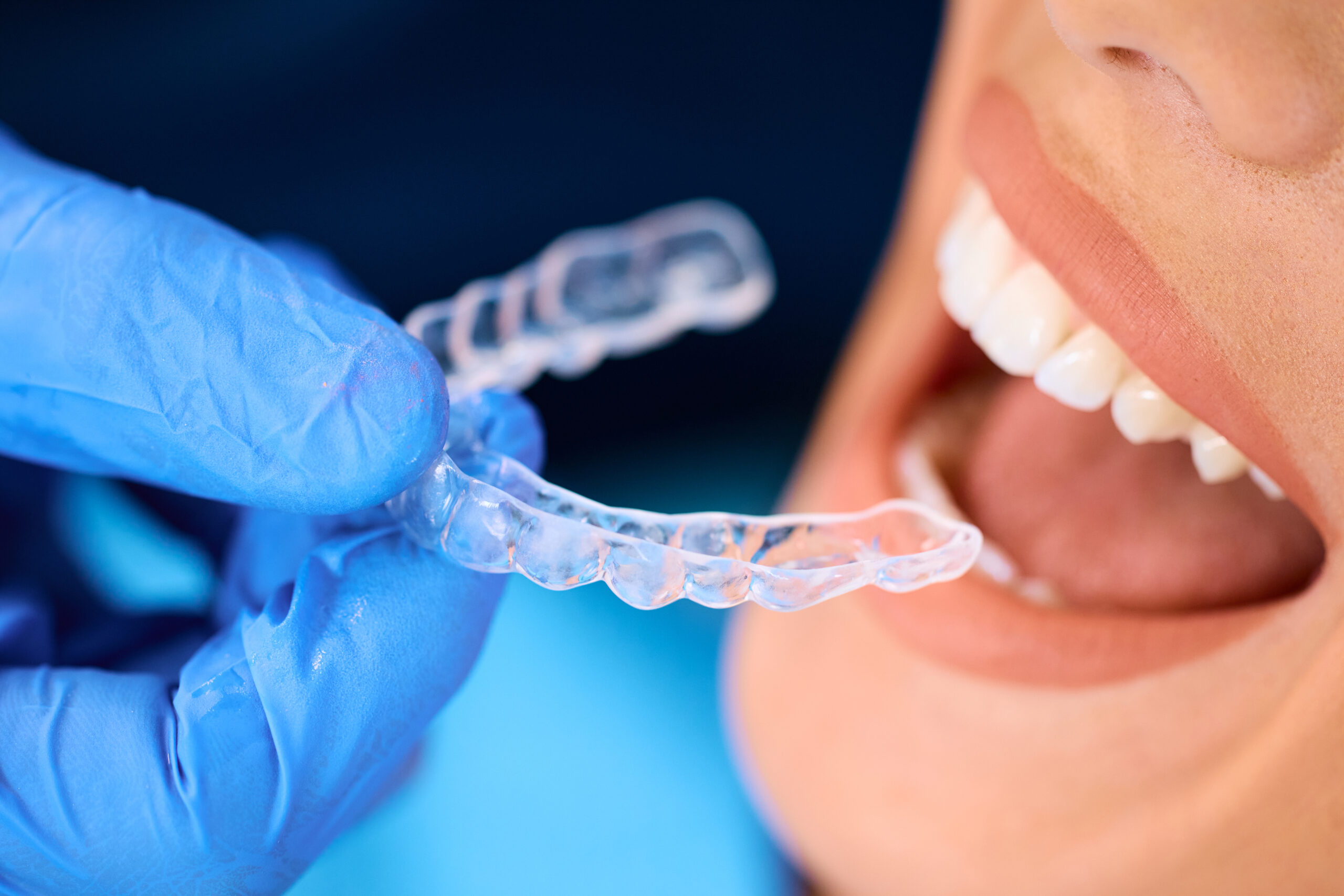 Close-up of dentist applying clear Invisalign aligner onto young female patient’s upper teeth at modern dental clinic in Macquarie Fields.